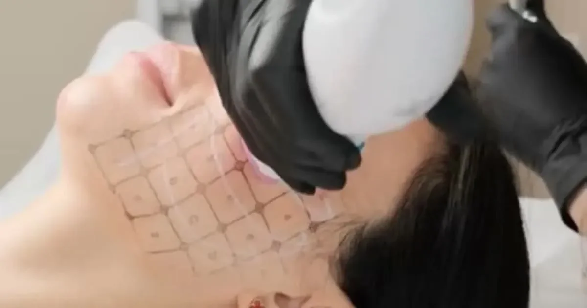 Thermage FLX handpiece placed on a marked jaw during a skin treatment at GemTech Rejuvenation Center
