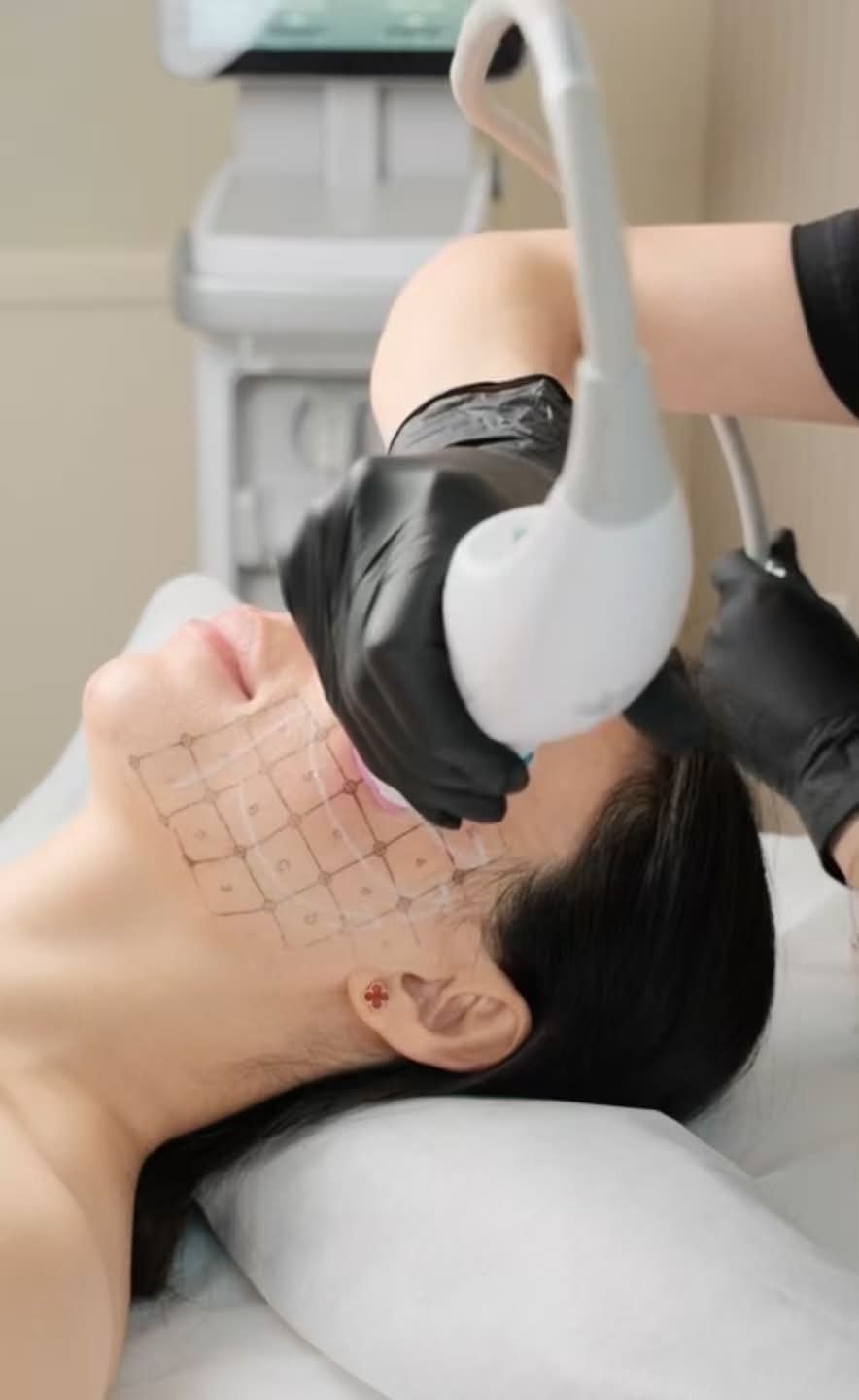 Thermage FLX®