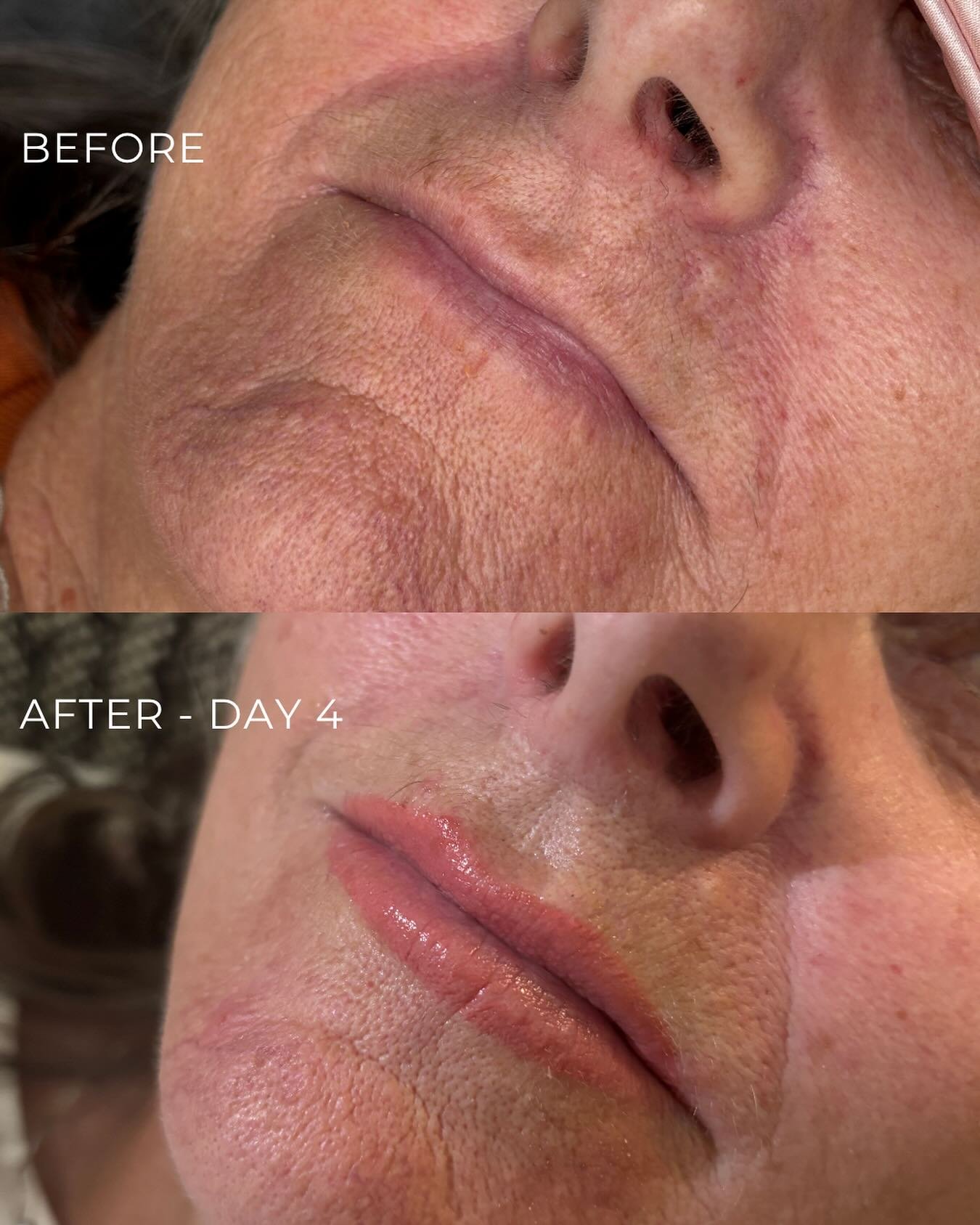 Before and After Lip Blush. My lovely model was after more definition of shape and a pop of colour to bring her lips back to life. Day 4 is almost healed and in her case she hadn&rsquo;t started peeling yet so the final colour result is still yet to 