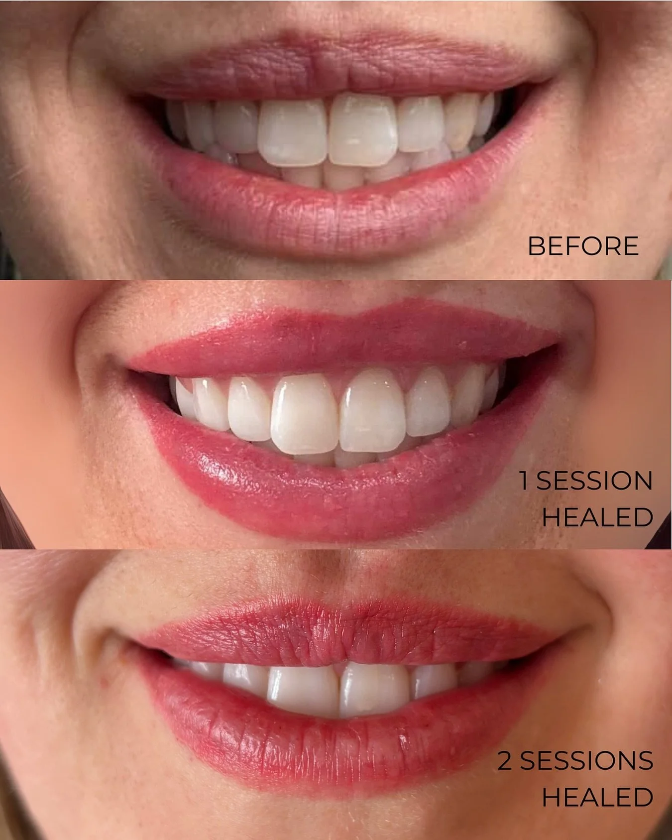 ✨ Lip Blush Transformation ✨
From natural to beautifully defined and radiant.
💋 Top: Before
💋 Middle: Healed after 1 session (colour continues to bloom over 5 weeks)
💋 Bottom: 1 week Healed after 2 sessions
Lip blush is a gradual process and most 