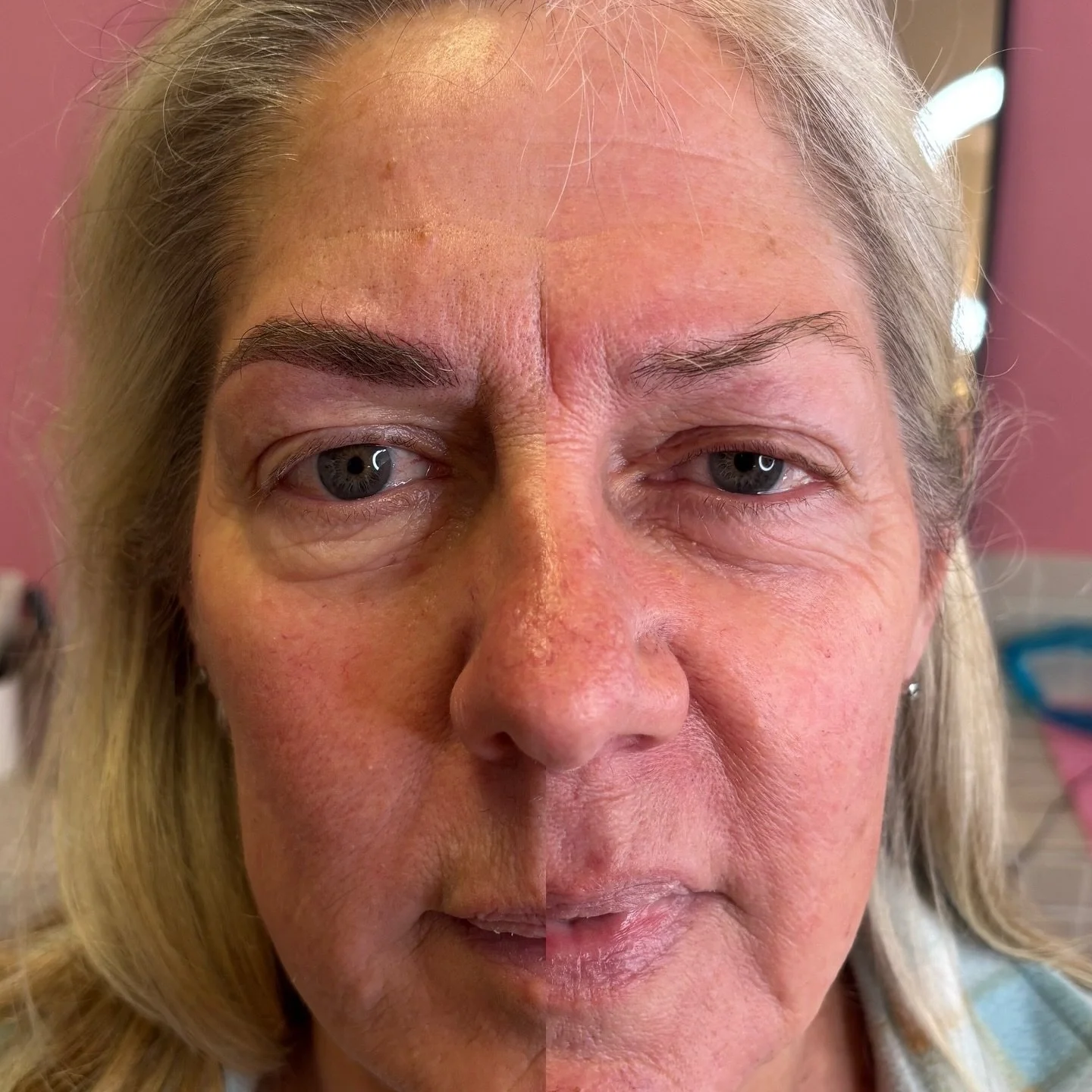 Nano Combo brows before (right) and after (left) This technique is for those who want more of a make up look with a touch of the natural hair strokes look at the front. Stay tuned to see the healed result when my client returns for her touch up appoi