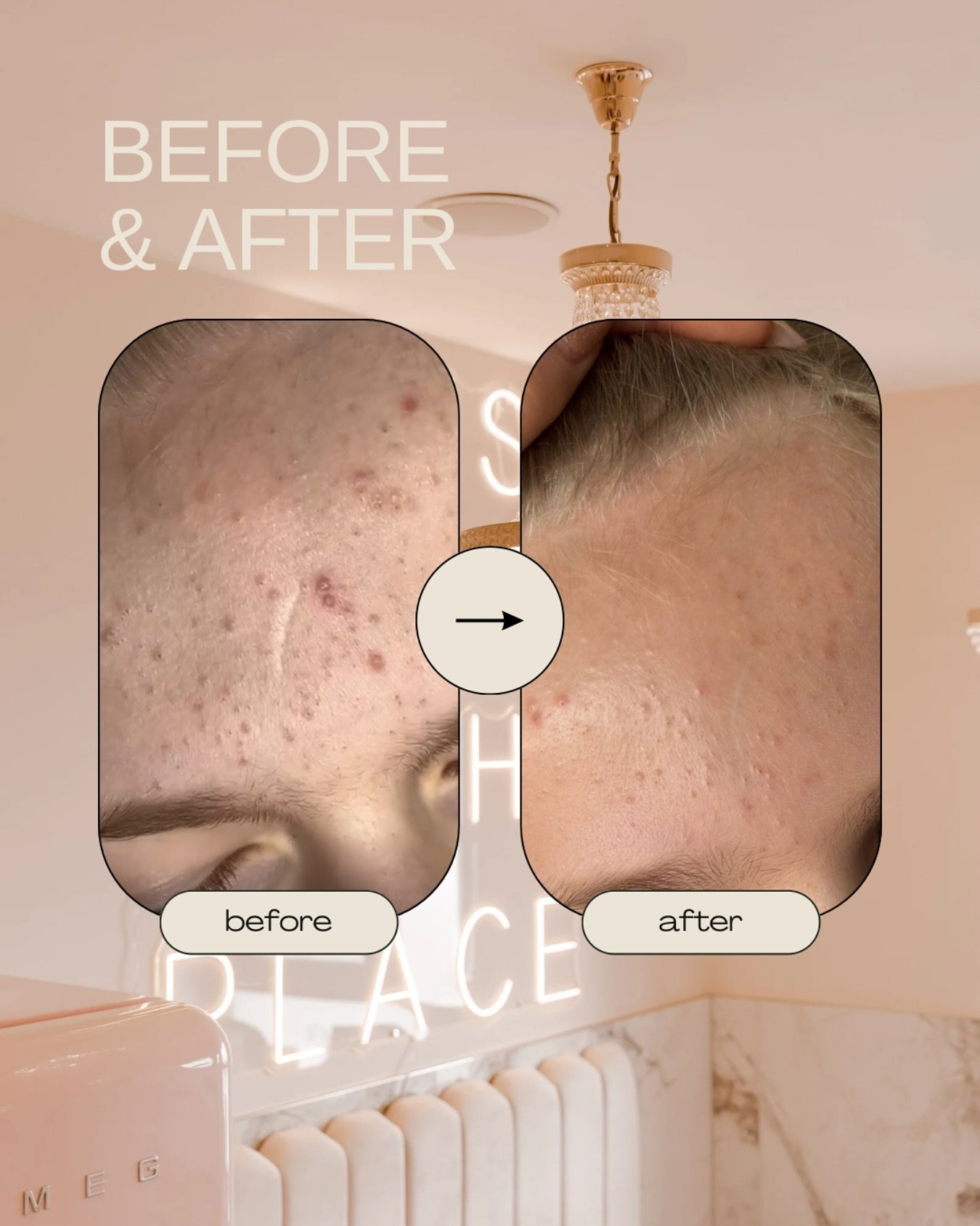 The power of skincare ✨ This before and after were taken ONE WEEK apart and is thanks to Obagi Clenziderm Pore Therapy, basically a deep-clean for your pores. It&rsquo;s packed with 2% salicylic acid to help unclog, clear, and tighten. Bye-bye breako