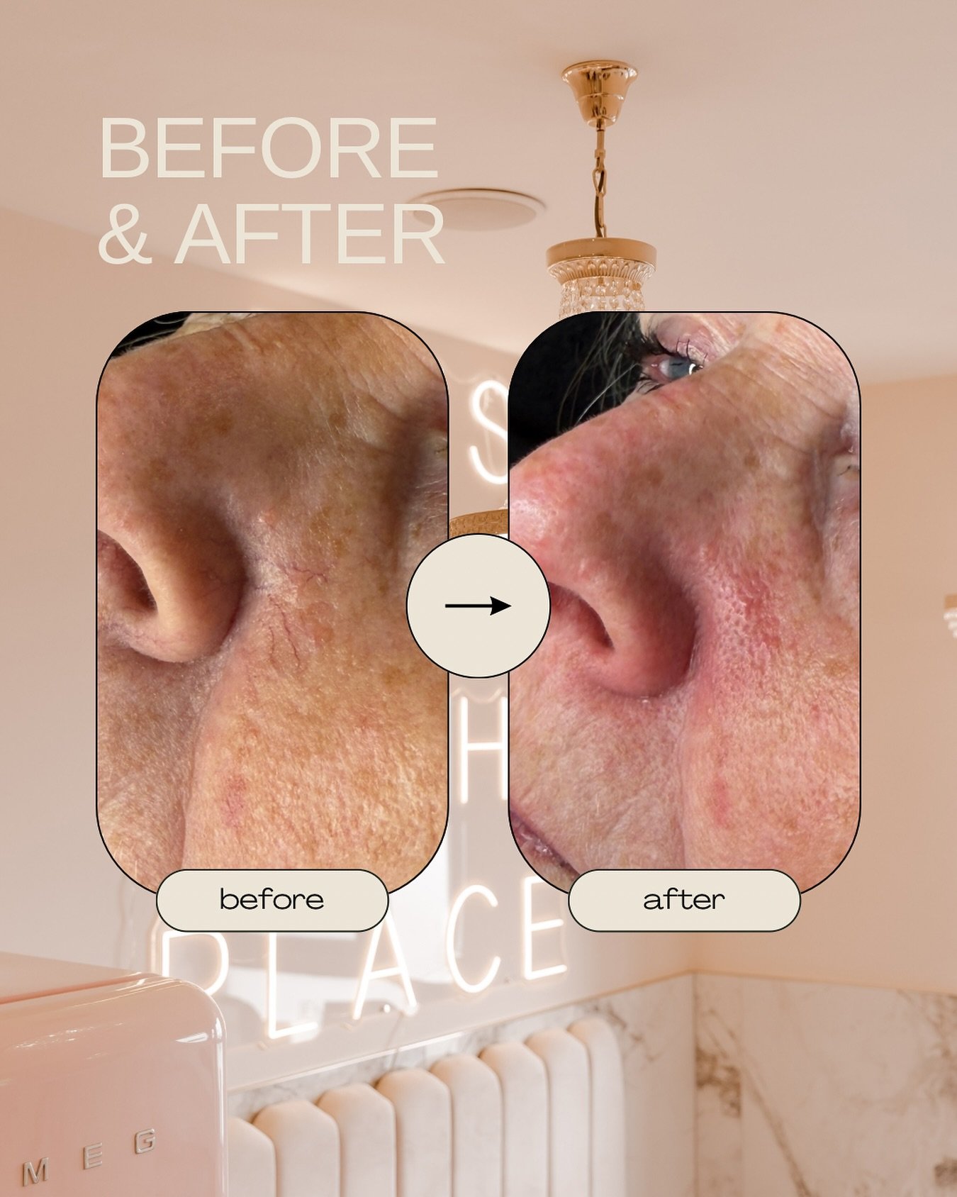 Spider veins vanished in minutes ✨ 

Book your consultation/patch test now for IPL with our @lumenis.uk StellarM22 - prices for small areas like this start from &pound;25
