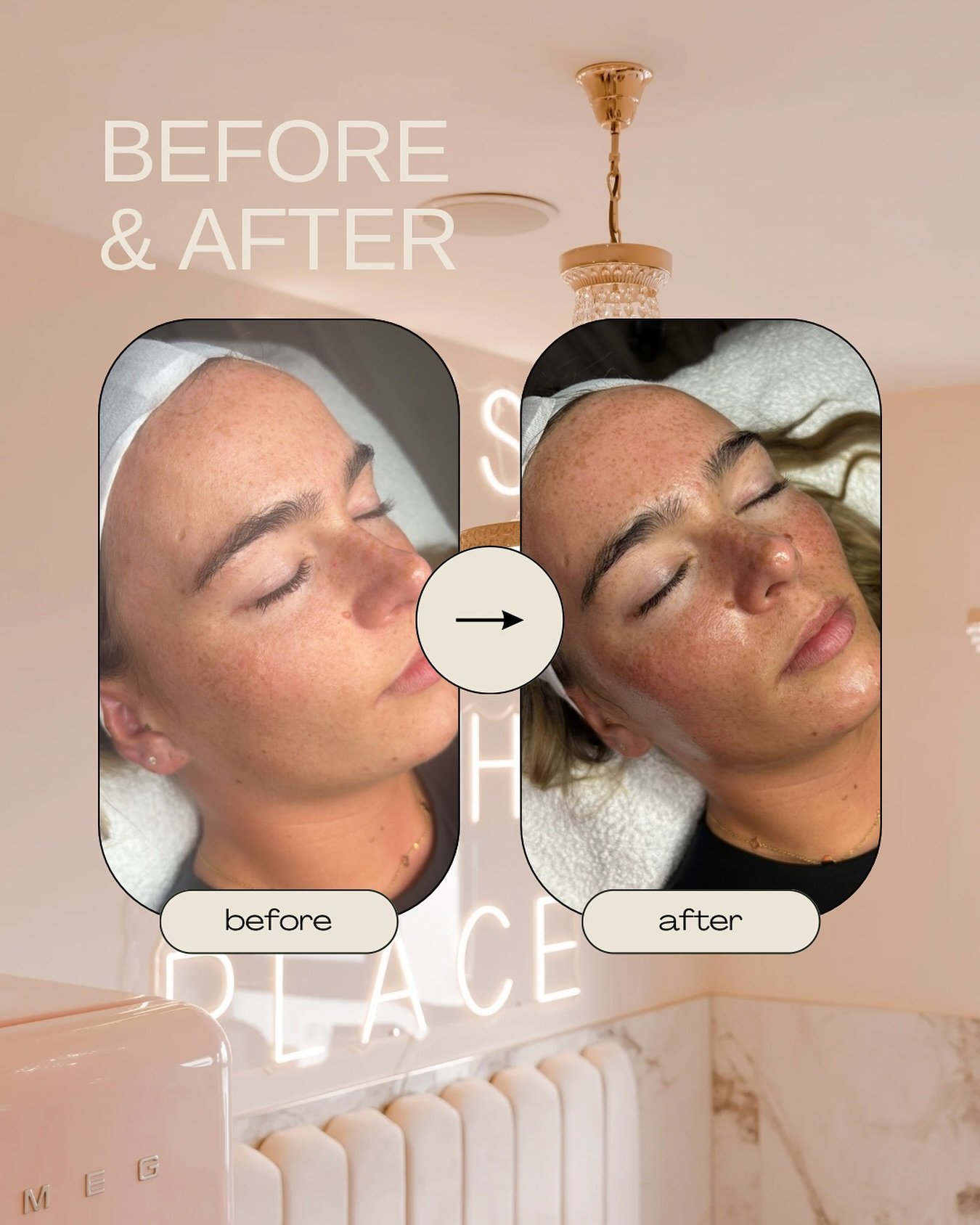 ✨ Get that glass skin glow! ✨

Hydrafacials cleanse, exfoliate, extract, and infuse your skin with hydration, leaving you refreshed, radiant, and ready to glow! 💦✨

Perfect for all skin types. Book now for the best skin of your life. #Hydrafacial #G