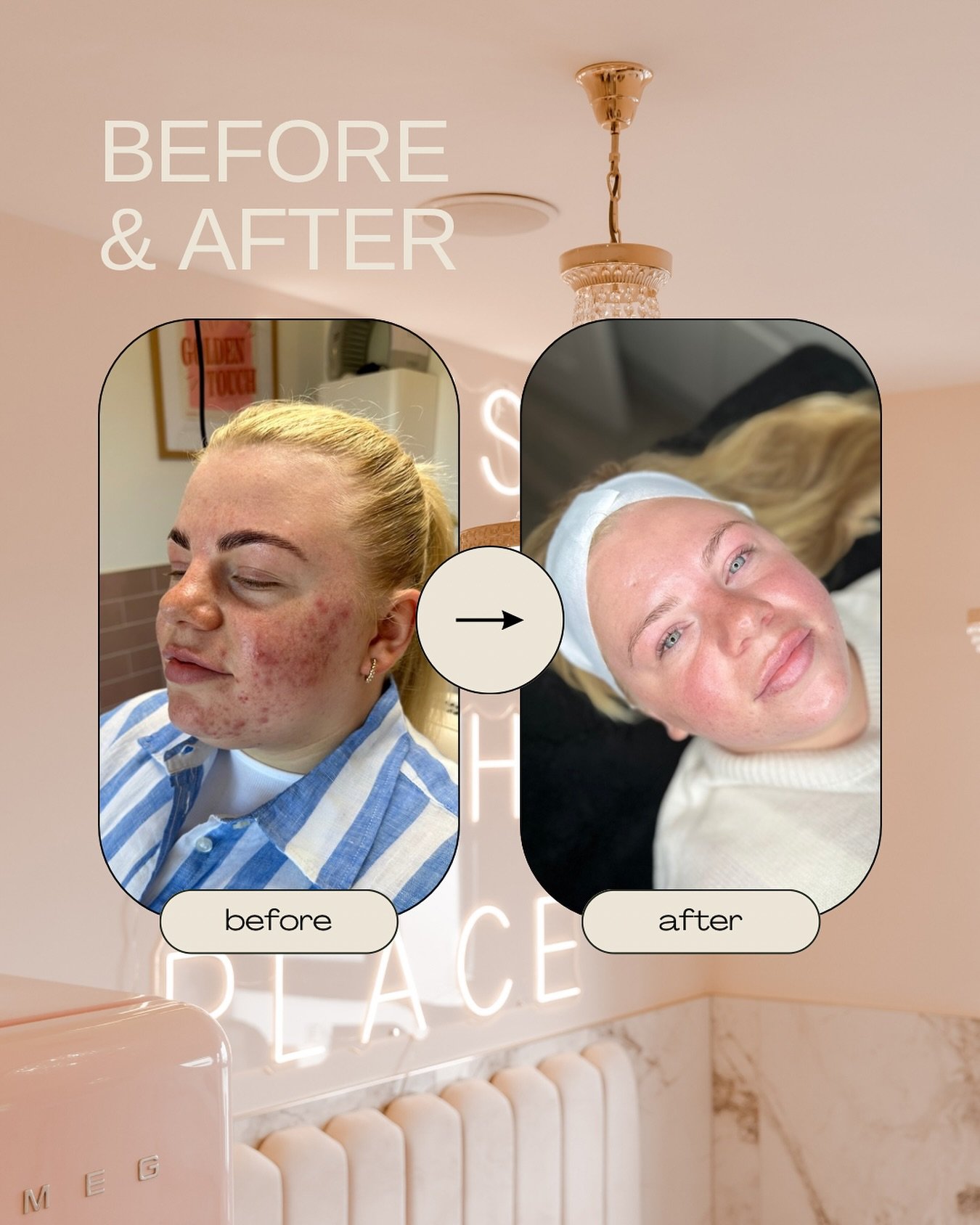 POV: you stuck to the treatment plan and cleared your acne 🩵✨