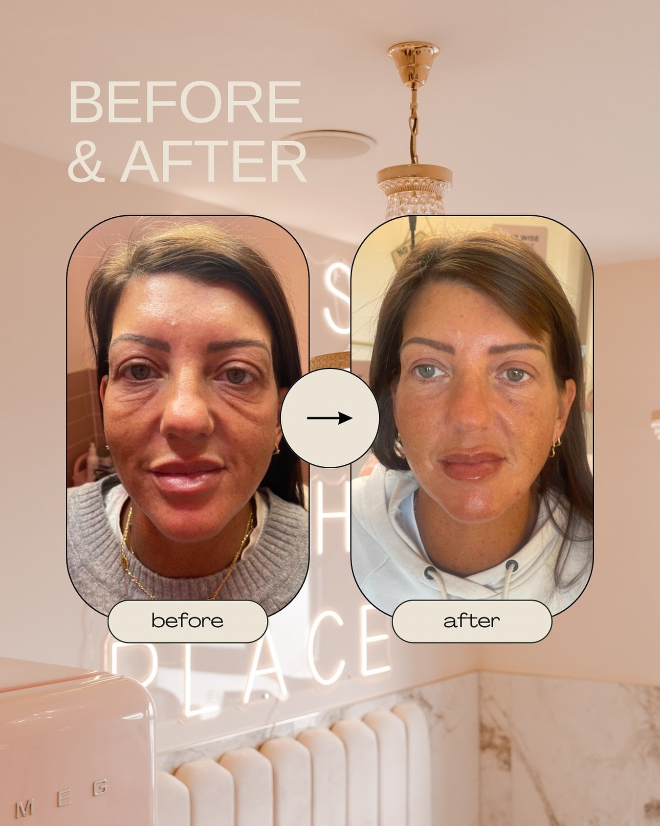 The power of Polynucleotides 🧬 

This lovely client came to us last year for &lsquo;Multiple Dermal Fillers&rsquo; with Jen. After a thorough consultation, Jen decided the best route to achieve the results she wanted was to go with Polynucleotides t