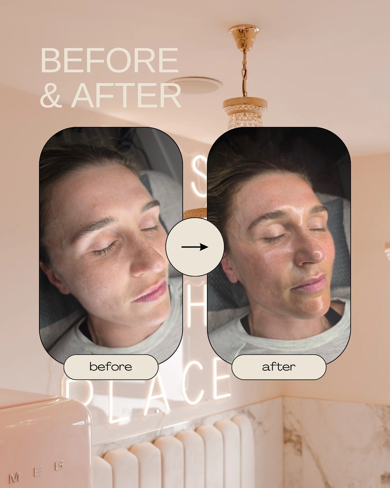Adding life back to your skin with HydraFacial 💦