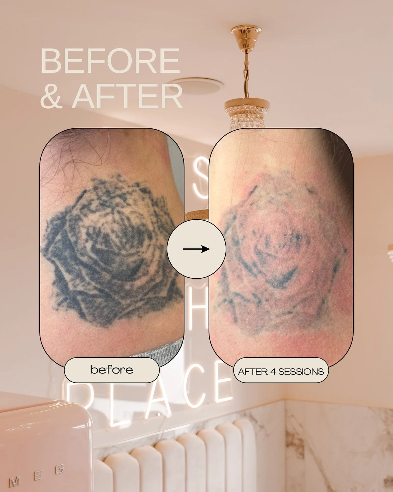 4 sessions of tattoo removal later&hellip; still a few more sessions to go but what a difference!! 

Book your consultation/patch test now ✨