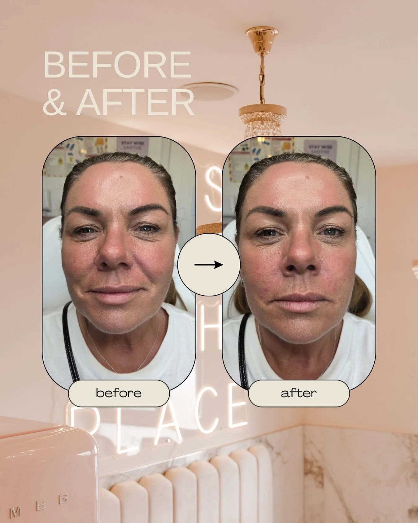 Bye bye smile lines 👋
Nasolabial folds softened in minutes by @aimeegoundry_jsa with dermal filler ✨💉