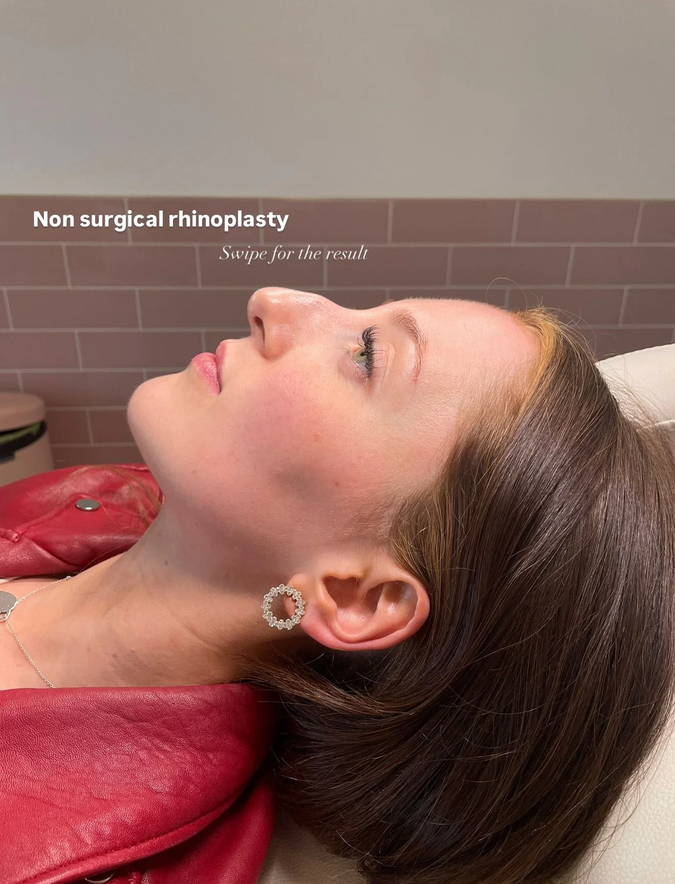 💉Non-surgical nose job = instant results, zero recovery. Sculpt your profile without going under the knife.

Treatment by Jennifer 💕