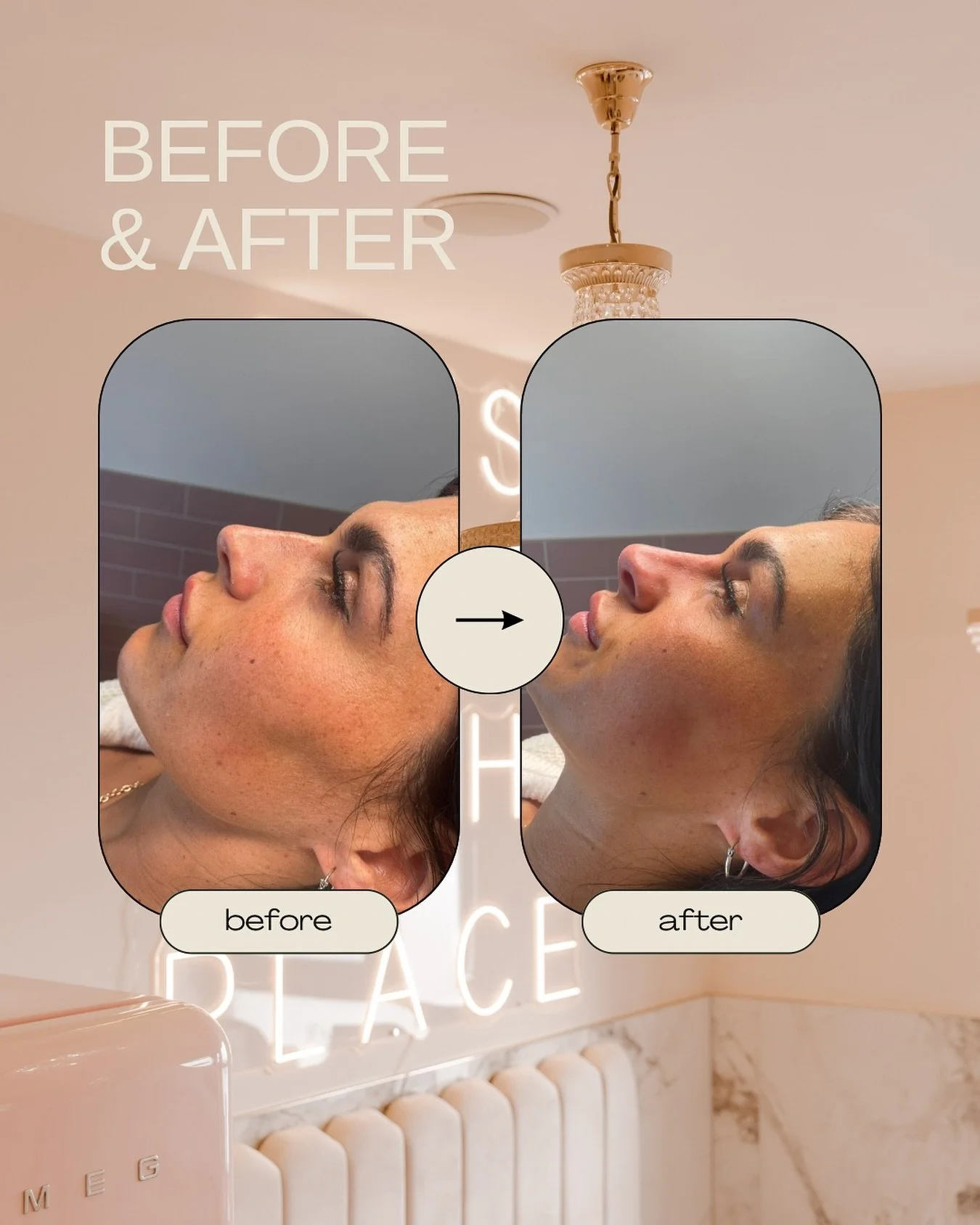 A little tweak, a big difference ✨

Non-surgical rhinoplasty by Jennifer to soften and refine the side profile, no downtime, just sculpted vibes 👃🏼💉