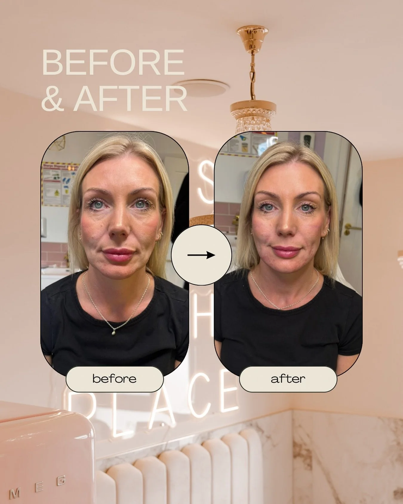 From tired to refreshed ✨ 

Nasolabial lines softened with subtle filler for a smoother, fresher look

Treatment by Jennifer 💉
