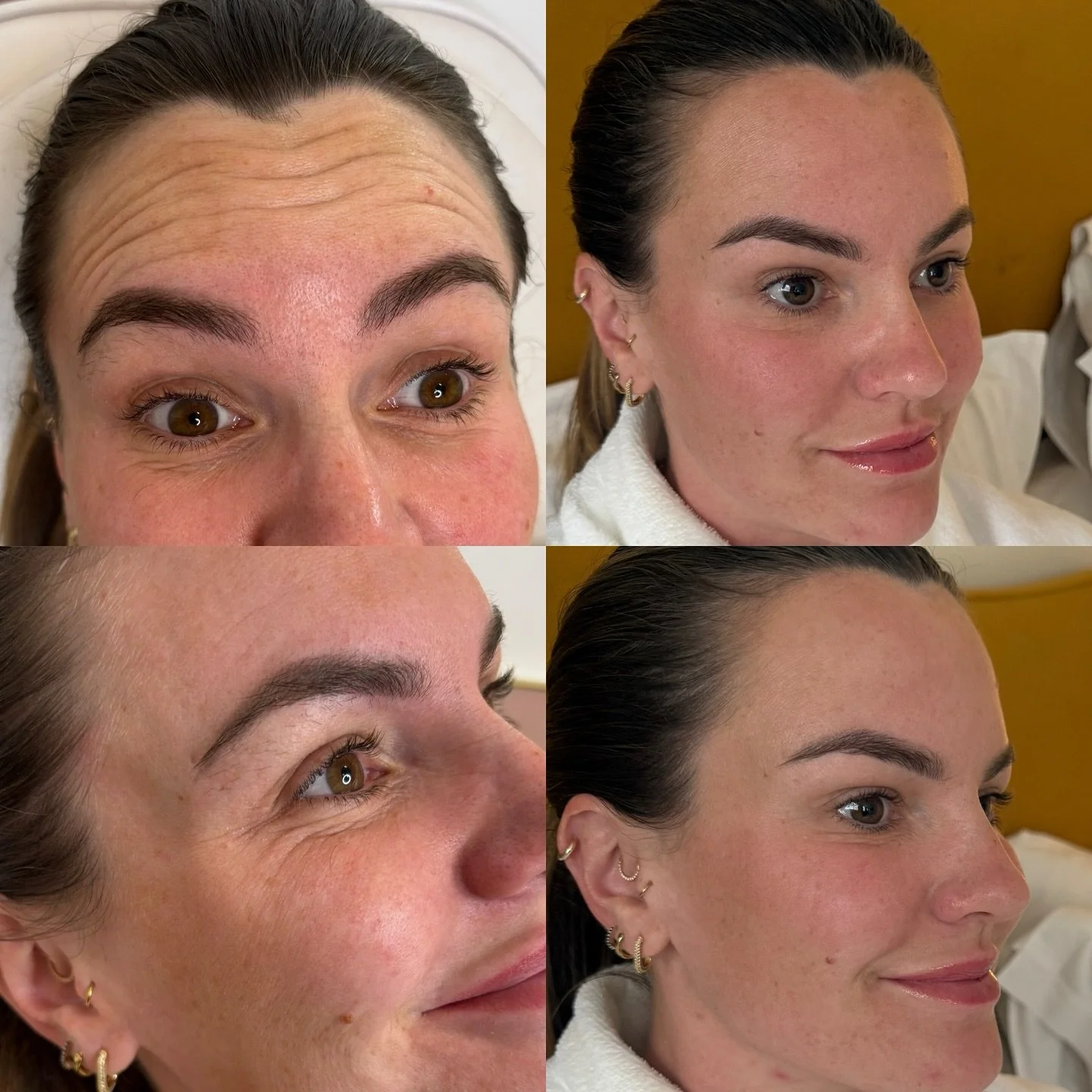 Proof that practice what you preach really works&hellip; Our very own clinic manager, Lauren, had a little glow-up with 3 areas of anti-wrinkle and a touch of Polynucleotides and wow&hellip; what a difference! Two weeks later she&rsquo;s looking fres