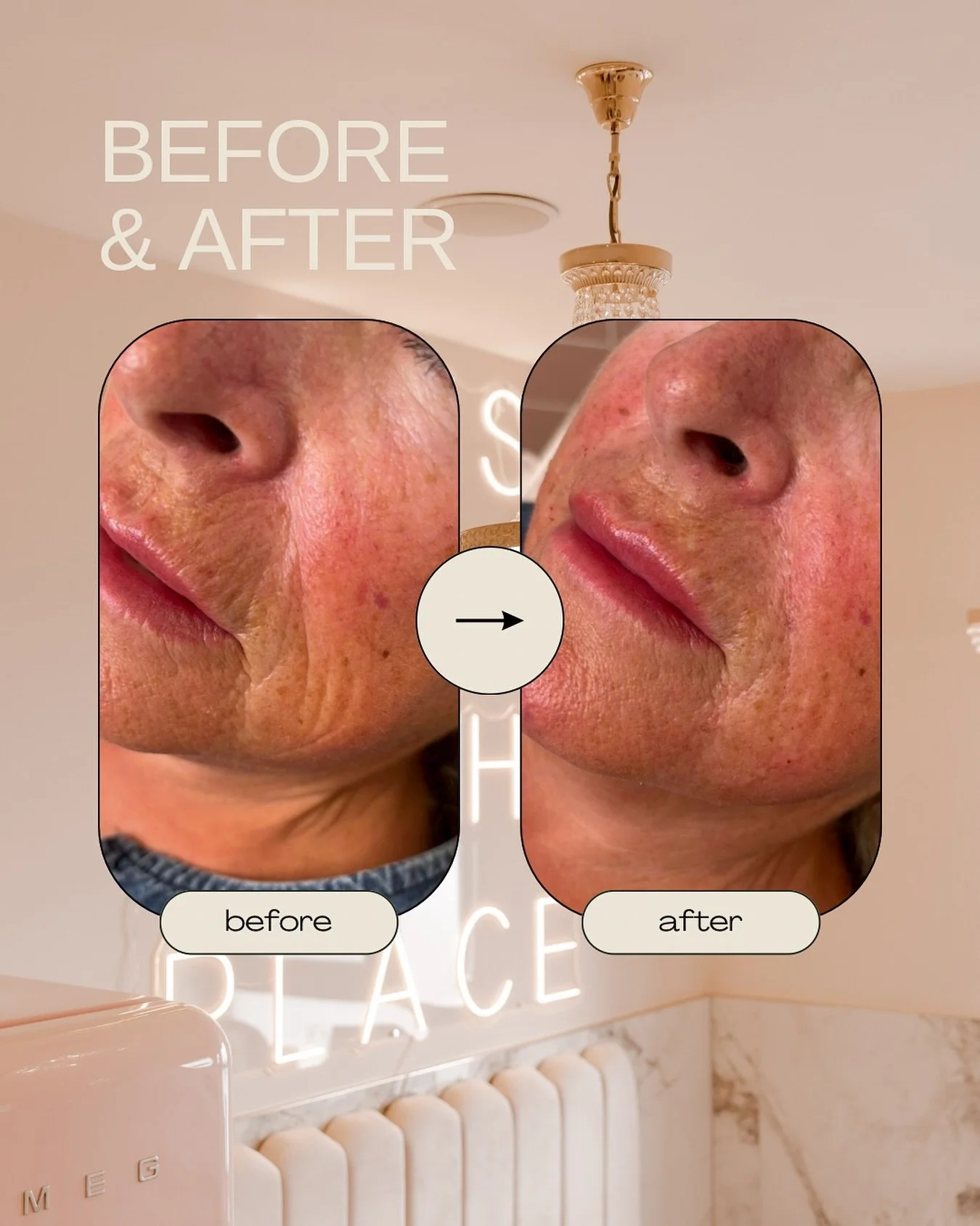 Subtle enhancements, smoother lines, and a naturally refreshed look ✨
