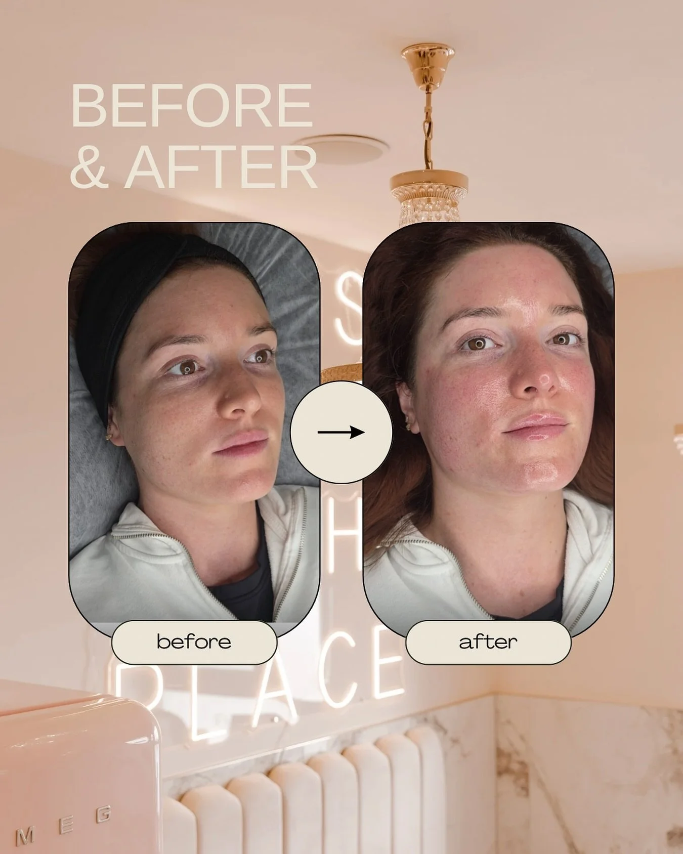 Nothing beats that post HydraFacial glow ✨