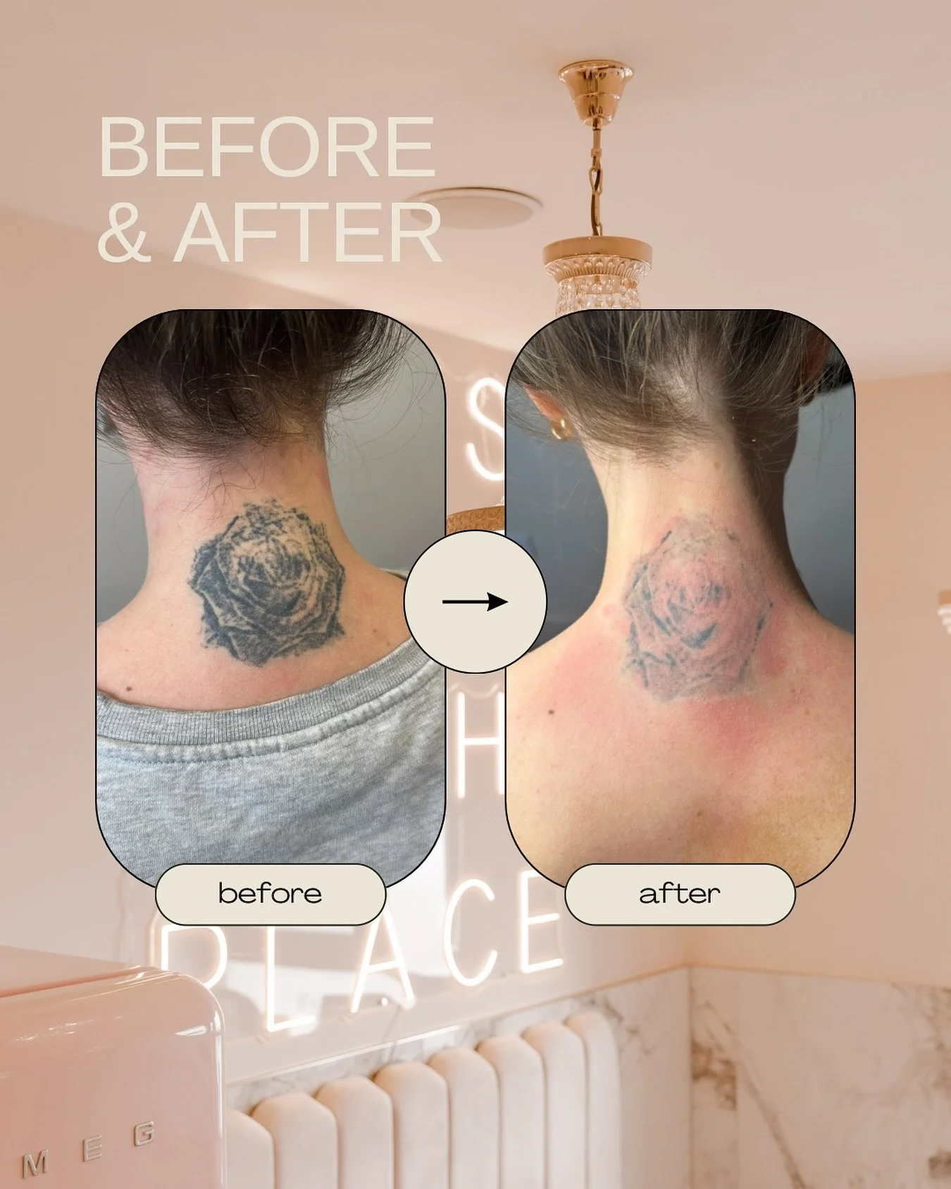Say goodbye to unwanted tattoos 👋🏼

This is before &amp; after 4 session of tattoo removal. Probably 4 more sessions to go&hellip; ⚡️