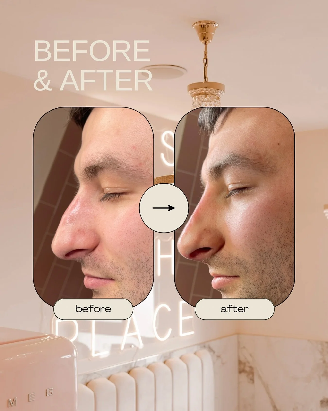 No surgery. No downtime. No regrets.
Just beautifully balanced results. 💫

Book your Non Surgical Rhinoplasty via the link in our bio 💕