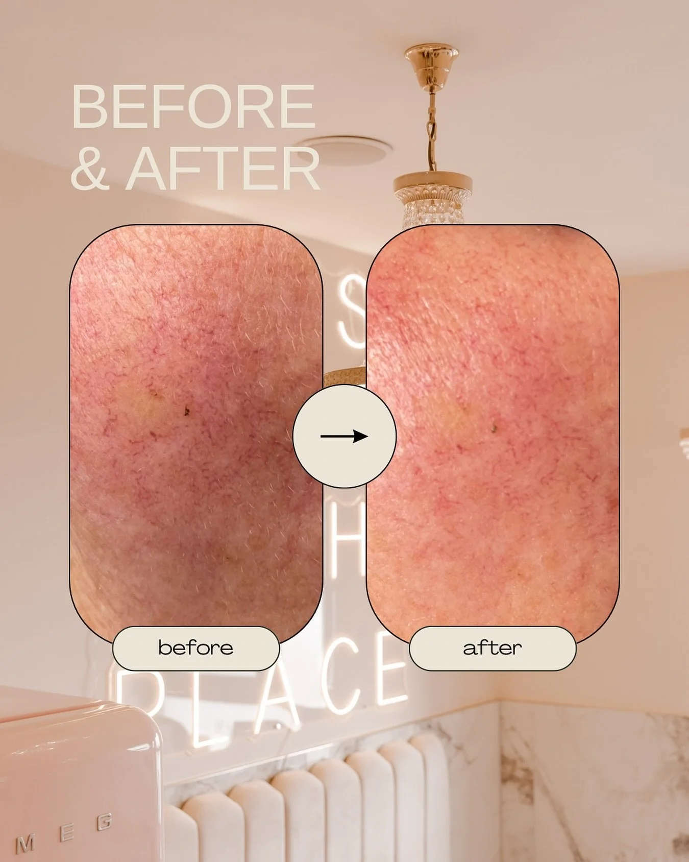 Rosacea? We&rsquo;ve got you 💕✨ IPL helps calm rosacea by targeting the dilated blood vessels beneath the skin, reducing redness and flare-ups for a clearer, calmer complexion.

Book your consultation now via our booking system 💫