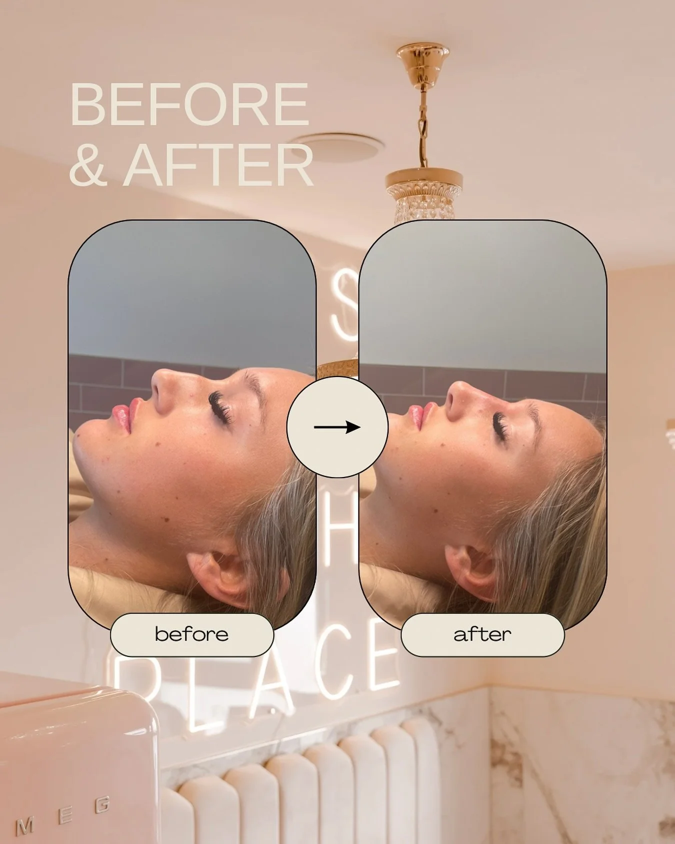 No surgery. No downtime. Just instant confidence.
Our non-surgical rhinoplasty can lift, smooth and define, all in under 30 minutes 💉