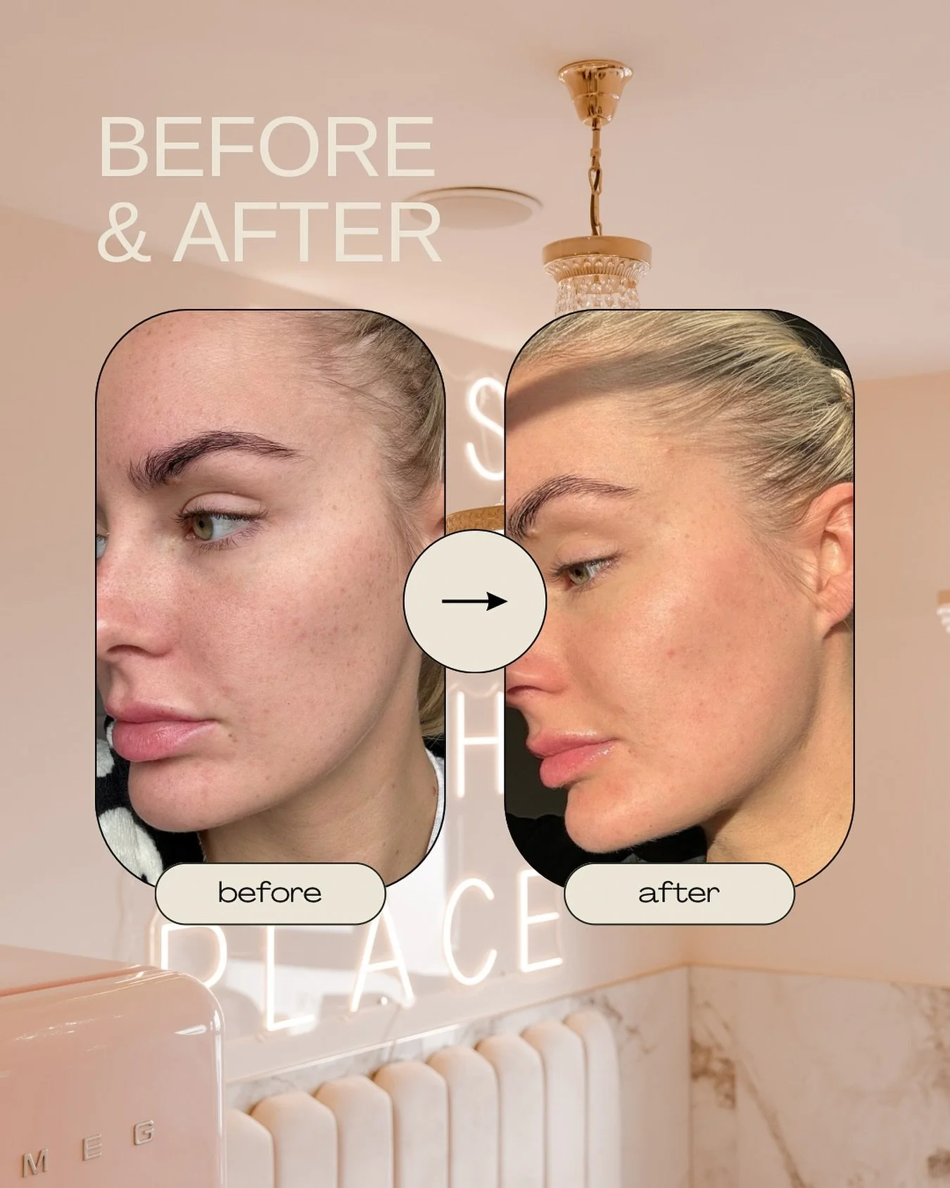 Before &amp; After just one PhotoFabulous on our gorgeous @nurselauren_jsa ✨

Look at the difference in her pigmentation already 🤭

Book your consultation/patch test now!