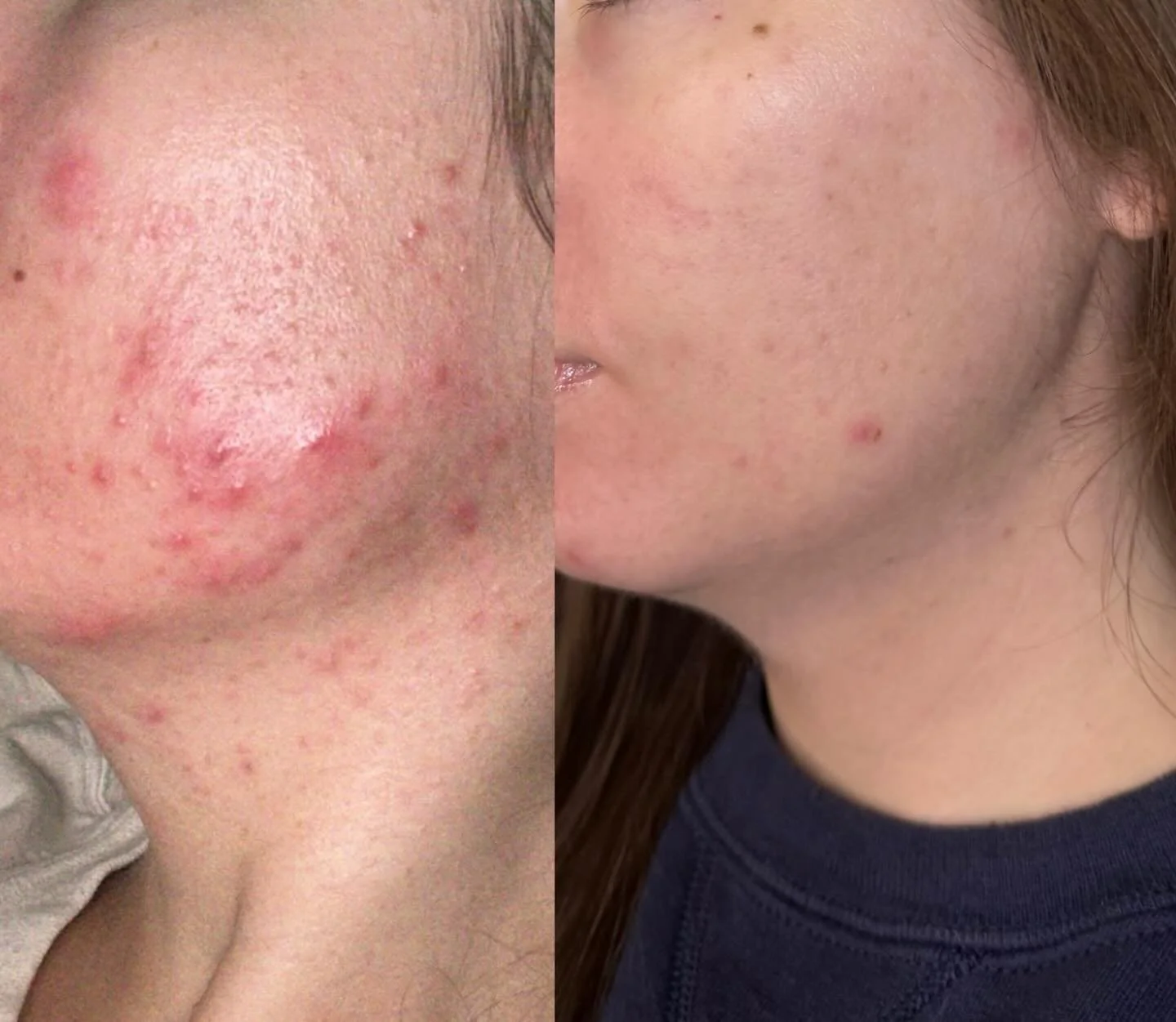 This right here is what brings my heart joy!!!&thinsp;&thinsp;&thinsp;
&thinsp;&thinsp;&thinsp;
As someone who has personally struggled with acne/cystic acne, I promise I get it. Acne is such an emotional thing. It&rsquo;s something you can never ful