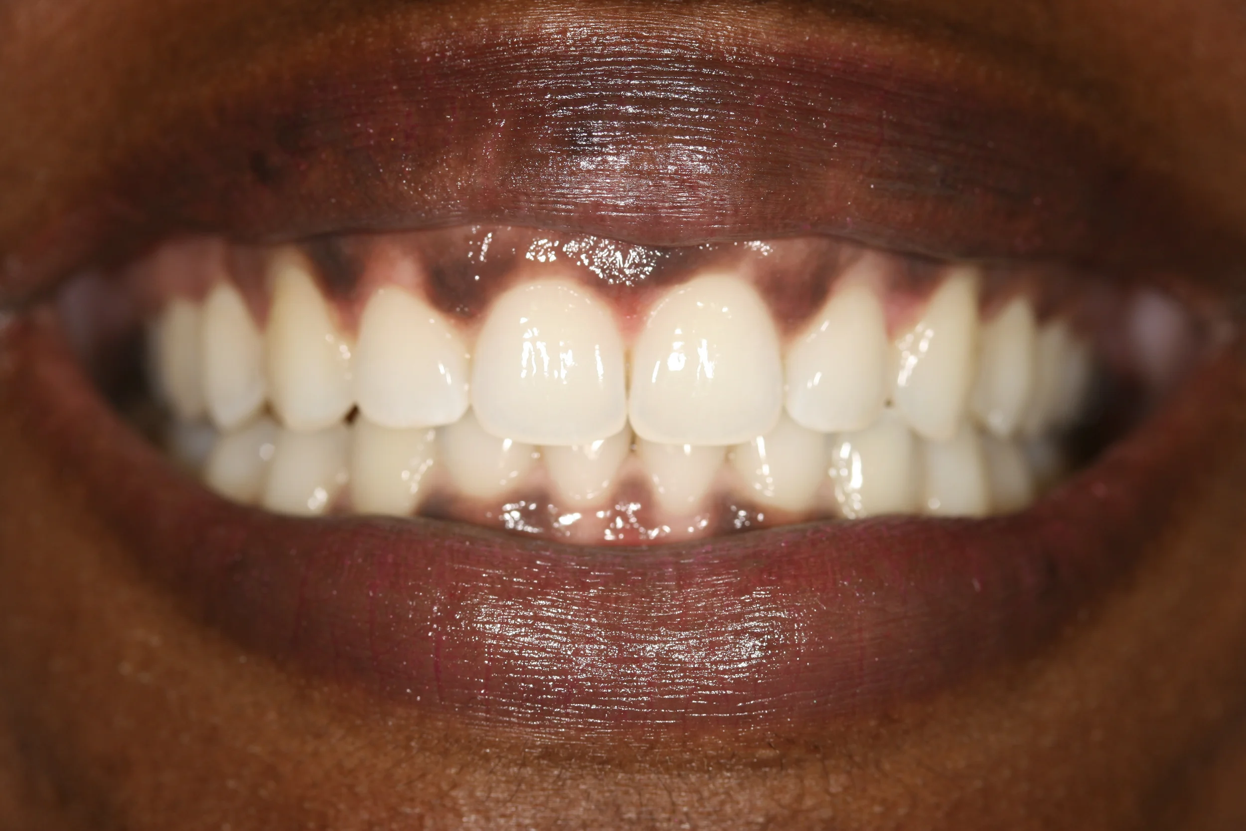 Andrea: Invisalign + Whitening - After