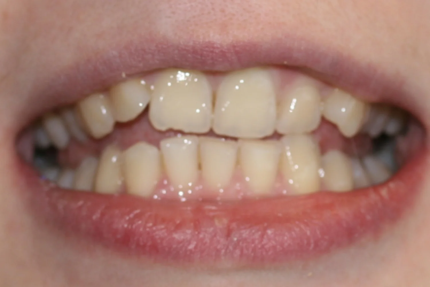 Alex: Invisalign + Whitening + Composite