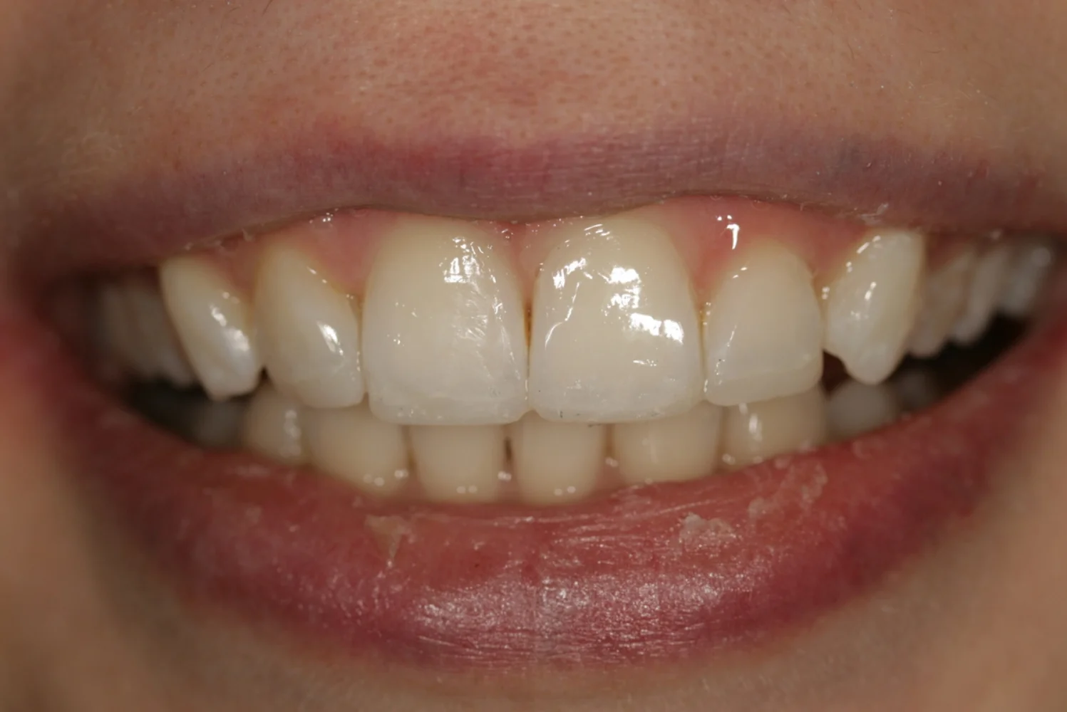 Alex: Invisalign + Whitening + Composite Bonding - After