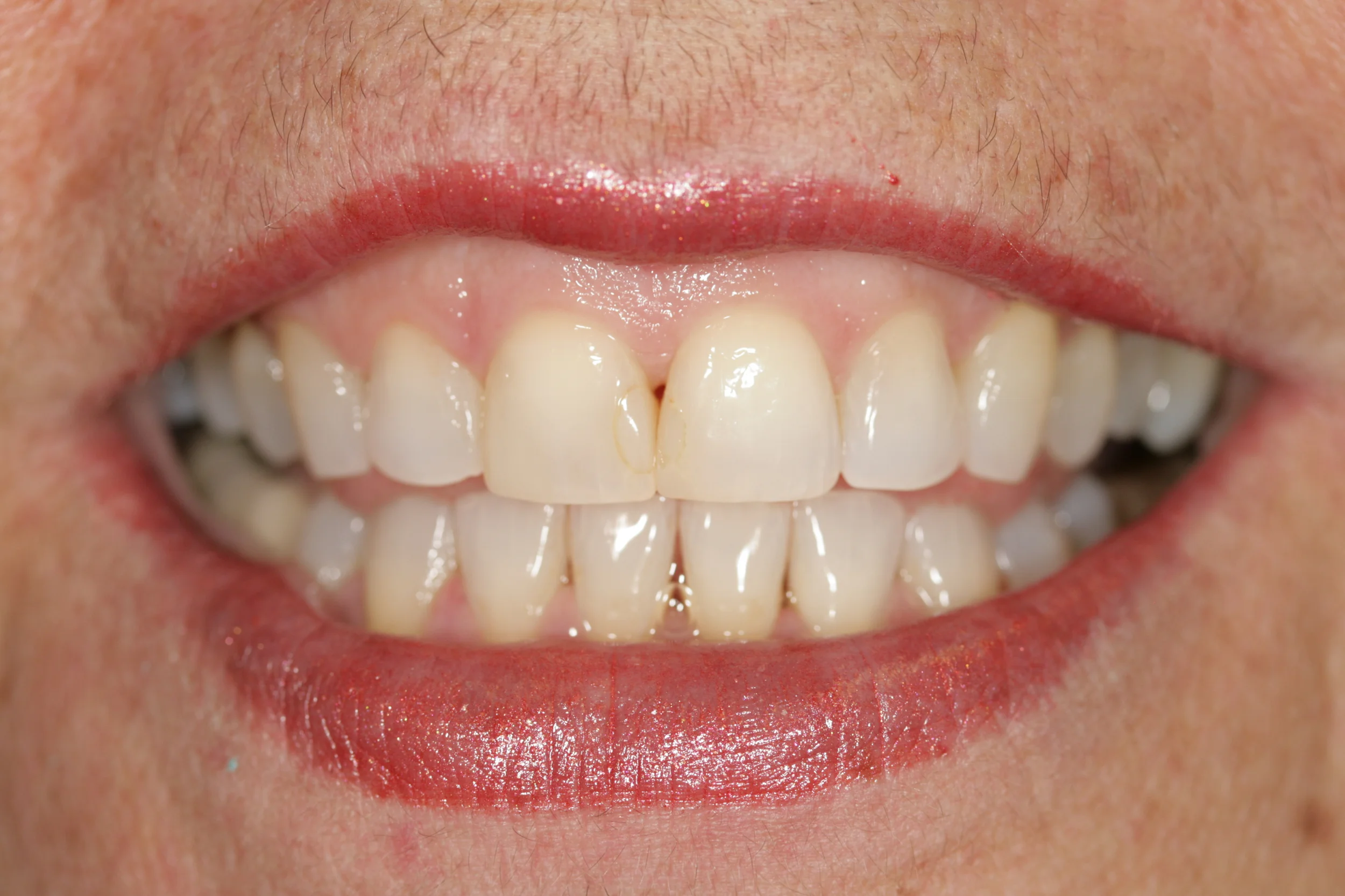 Arlene: Invisalign - After