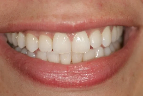 FraNcesca: Invisalign - After