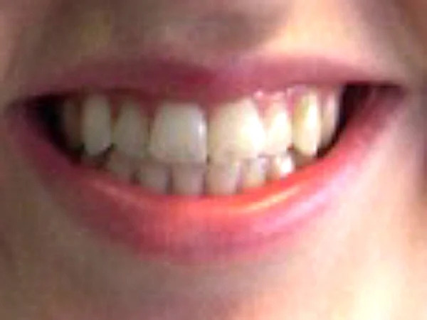 Lucy: Invisalign - Before