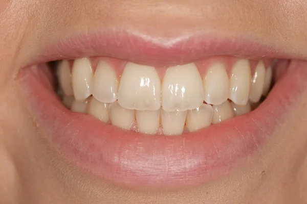 Lucy: Invisalign - After