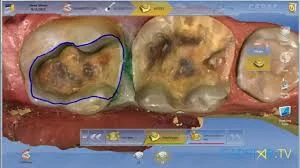 Smile Design Process - Preparation - The first step is to remove the dental caries and/or the existing filling.