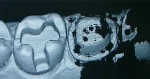 Smile Design Process - 3D Scan - The CEREC measuring camera then takes a three dimensional photograph of your tooth.