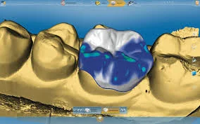 Smile Design Process - Computer Design - The contours of the ceramic restoration are designed on the computer monitor.