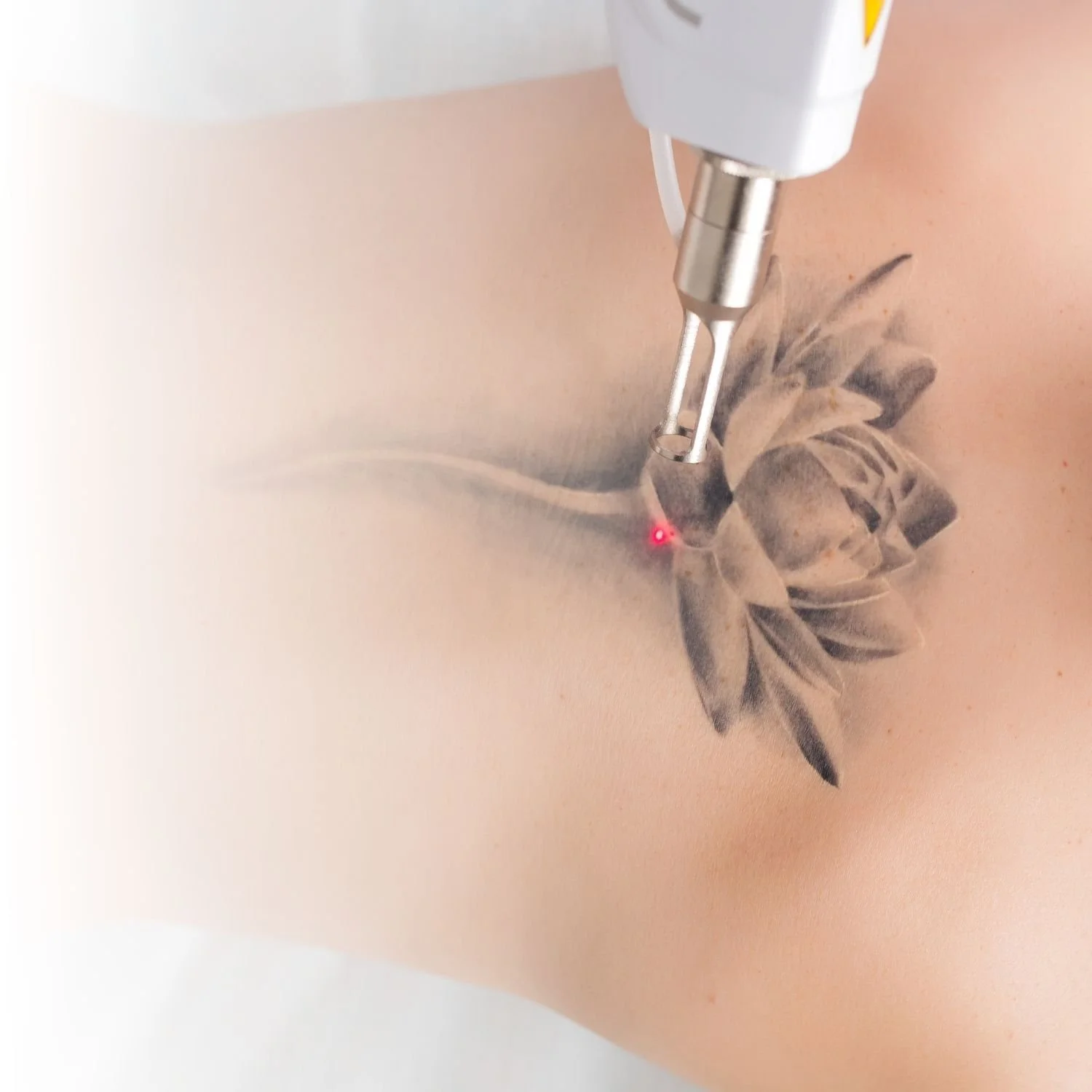 A laser removing a tattoo of a flower with leaves on skin.