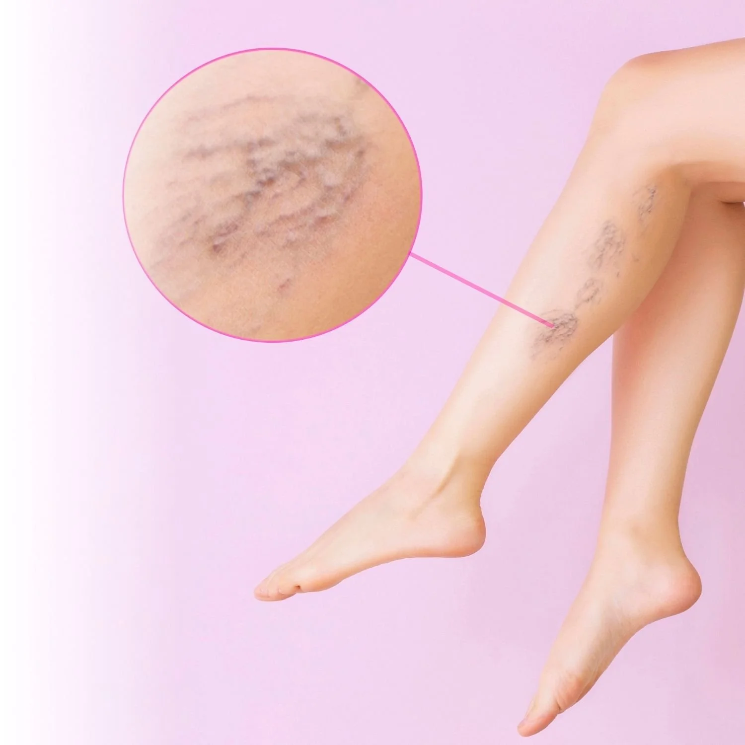 Close-up of a person's leg with visible varicose veins, highlighted with a magnified inset showing the skin's texture and veins against a pink background.
