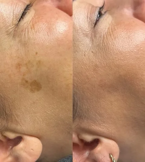 Before and after IPL skin rejuvenation for pigmentation