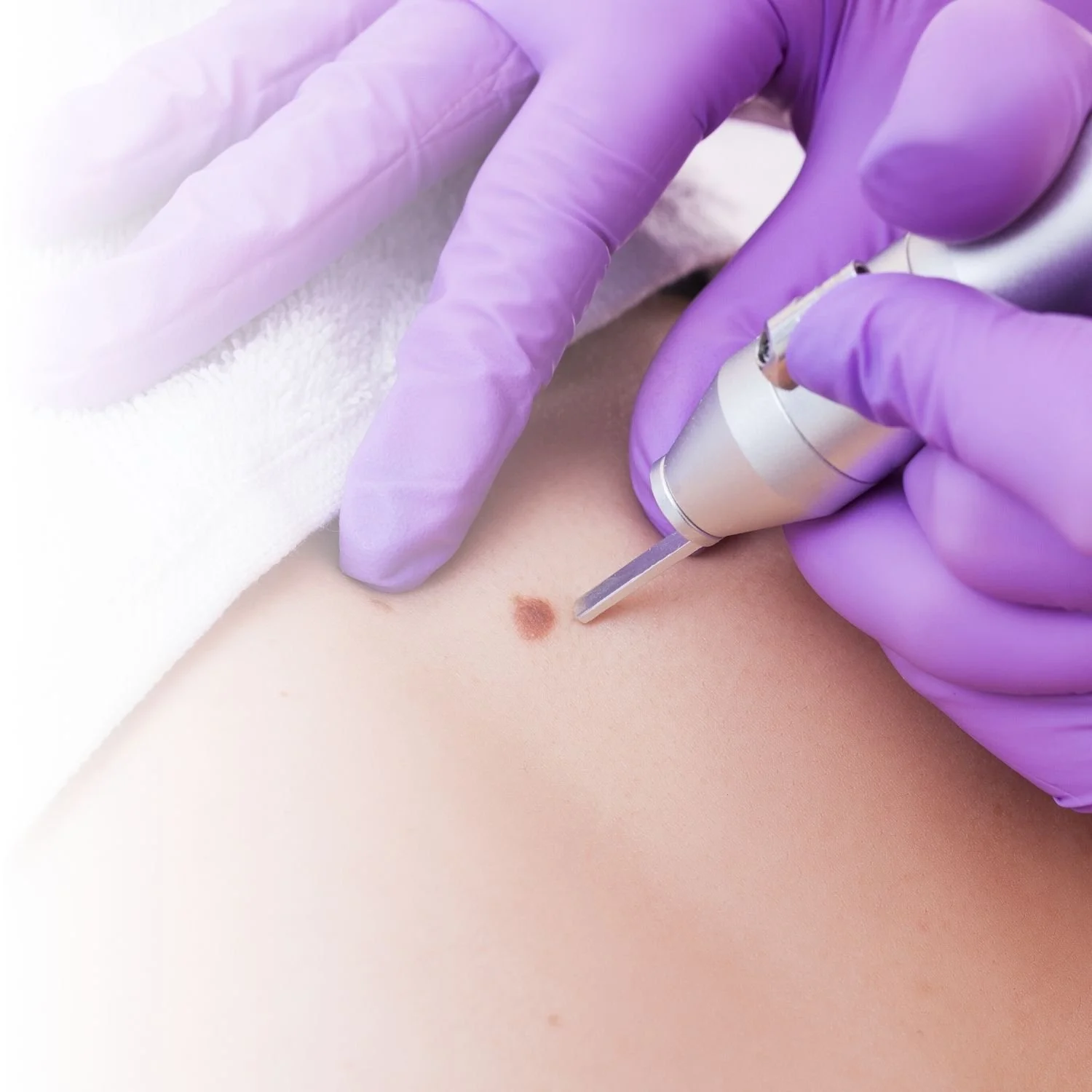 Close-up of a medical professional wearing purple gloves using a laser device to remove a mole from a person's skin.