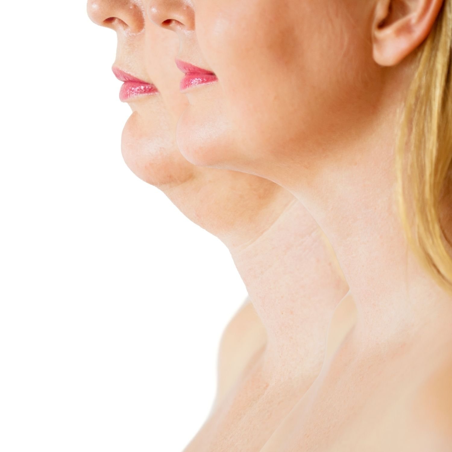 Side profile of a woman's face, showing half her lips, nose, and jawline, showing the results of Aqualyx fat dissolving treatment.
