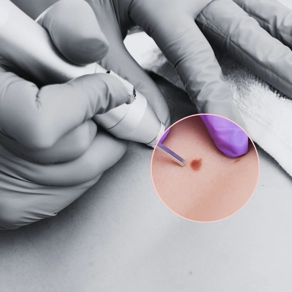 Mole & Skin Tag Removal: - Remove skin tags, moles and minor lesions safely with our advanced plasma soft surgery. Performed by Nurse Prescribers, this quick and effective treatment offers minimal downtime with clinically clean results.