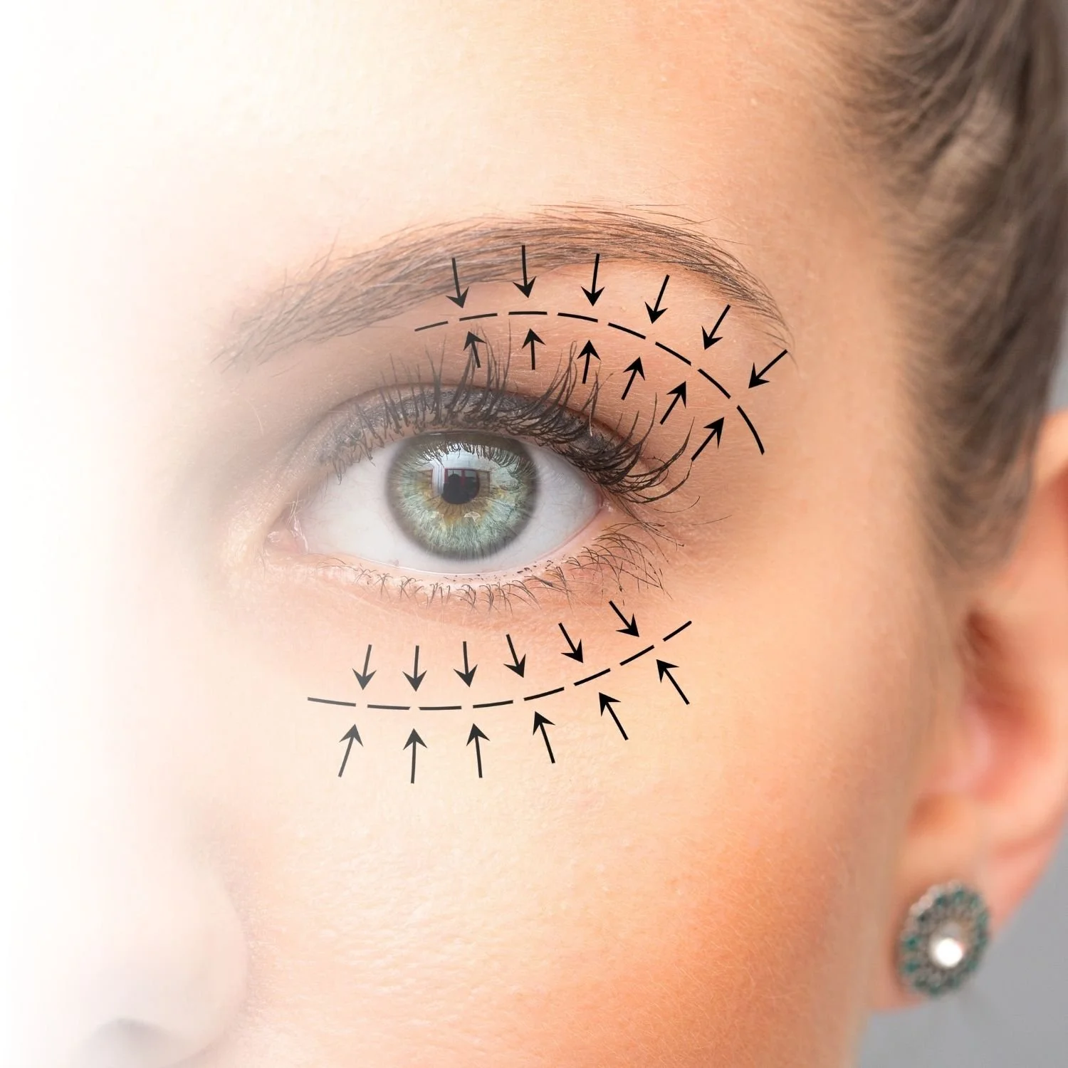 Close-up of a woman's eye with black lines and arrows indicating eyelid and under-eye areas, showing eyelid tightening.