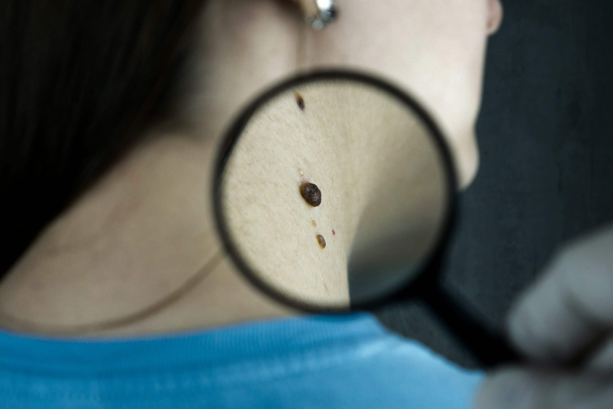 Skin Cancer Uncovered: Understanding Risks, Innovations, and Prevention