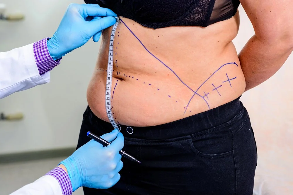 Can You Get A Tummy Tuck After A C-Section?