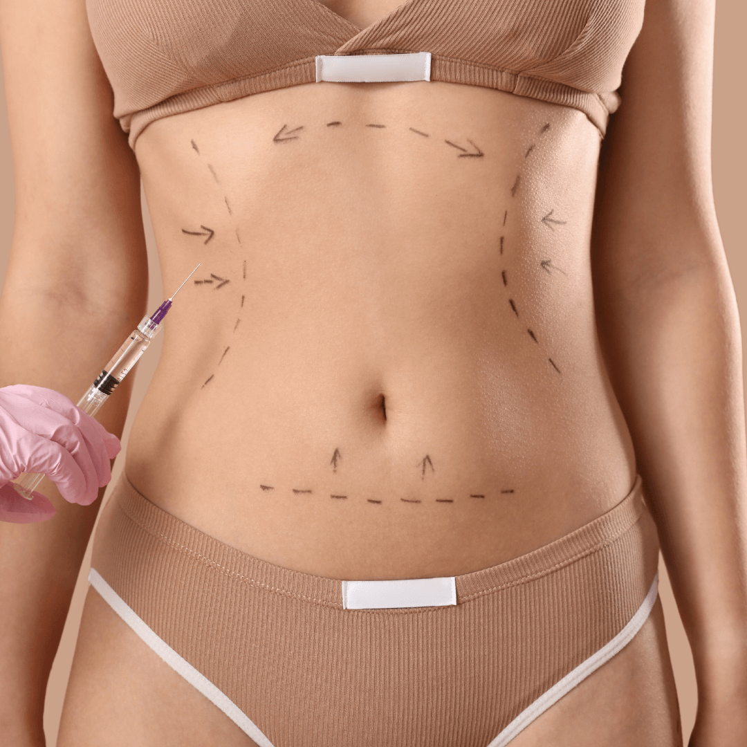 Woman with marks on her abdomen for cosmetic procedure, holding syringe.