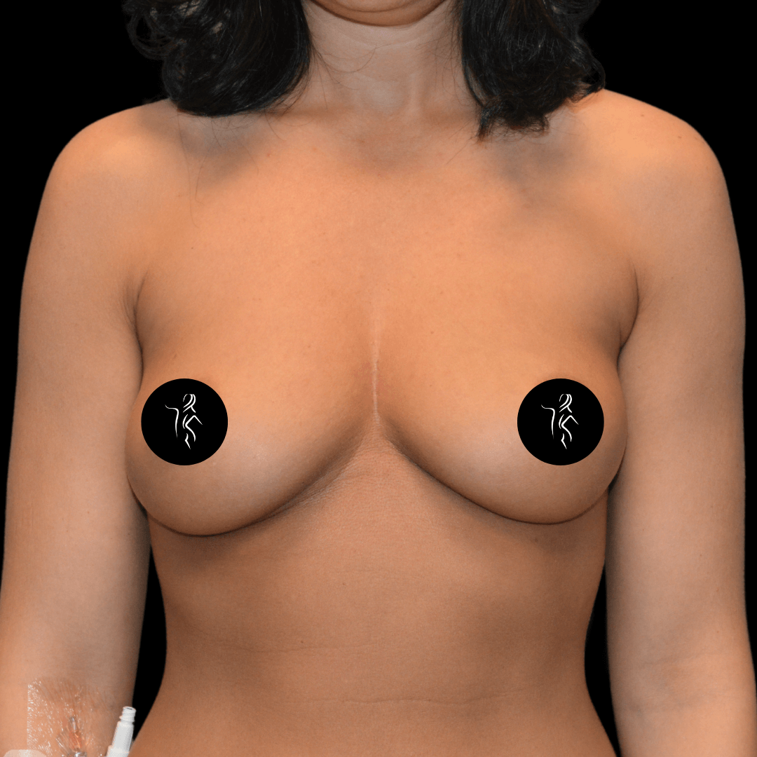 Woman with a visible scar on chest