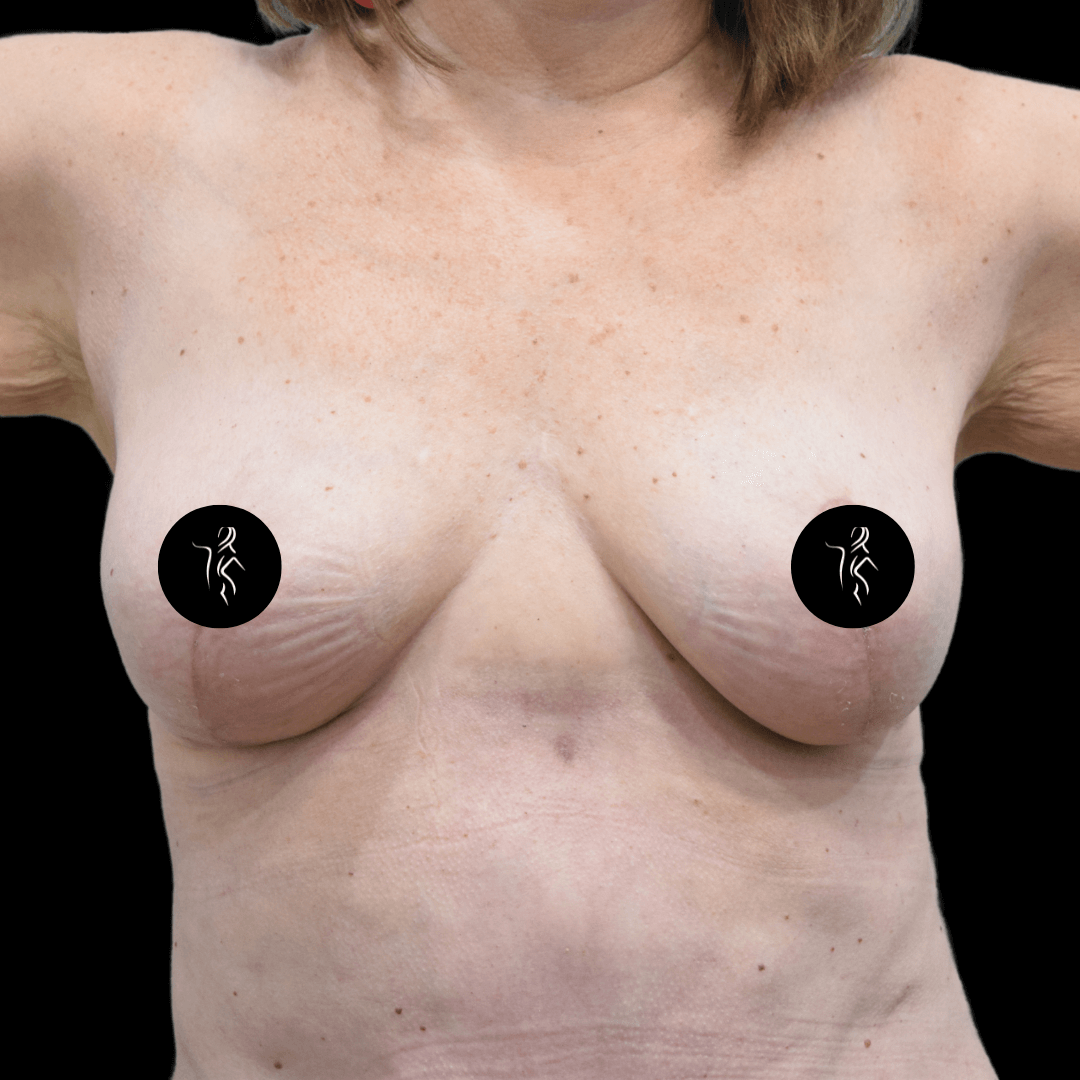 A female torso showing partial upper body with arms raised. Black circular logos cover the breasts.