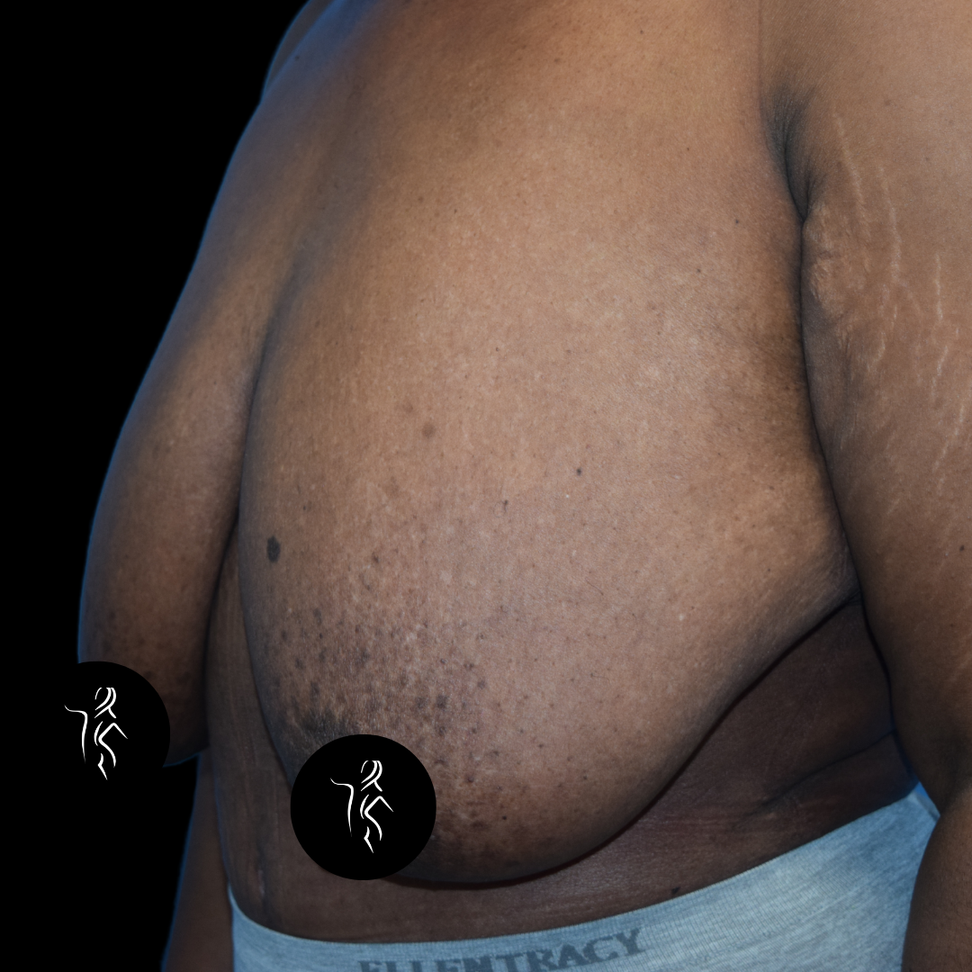 Close-up of a person's bare upper body highlighting the chest area with visible stretch marks and skin texture.
