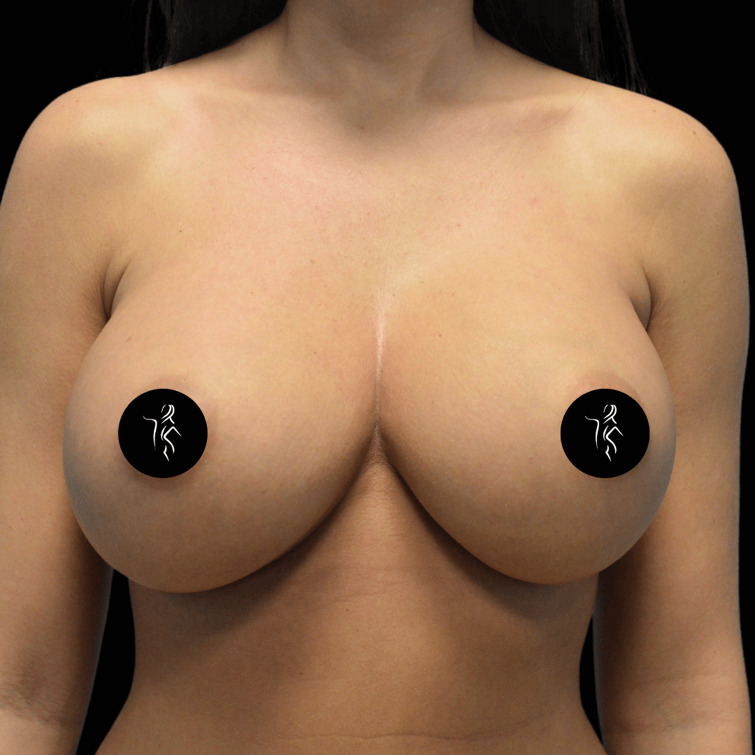 Close-up of a female torso with circular black stickers over the nipples, covering the chest area.