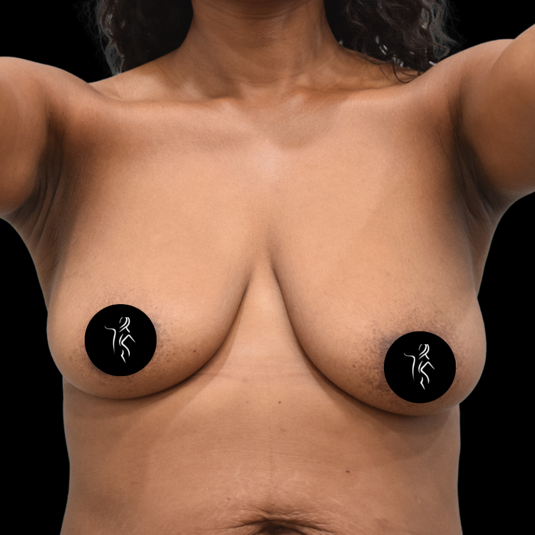 Woman's chest with black circles covering the nipples, black background.